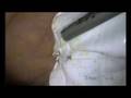 videos de Laparoscopic mesh repair of Spigelian hernia
