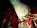 recurrent myoma with adhesion1