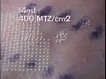 Fraxel Re:pair CO2 laser Tissue Contraction