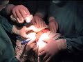 liposarcoma de mediastino