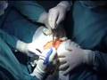 liposarcoma de mediastino