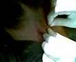 my perforacion
