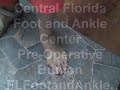 Pre-Operative Bunion Before Surgery