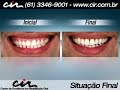 Pl�stica gengival. Cl�nica Odontol�gica CIR - Bras�lia (61) 3346-9001