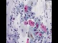 Histopathology Cervix --Low grade squamous intraepithelial l Histopathology Cervix --Low grade squamous intraepithelial l