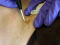 Dorset, Somerset, Bristol and Southwest England Mole Removal Surgery - cosmetic radiosurgery