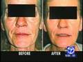 Thermage, Sculptra, Restylane, Botox - Live on the Air!