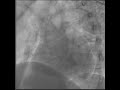Aortogram with Aortic Insufficiency