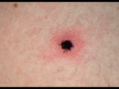 how to remove ticks