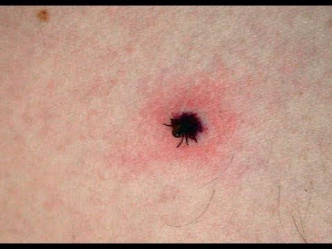 how to remove a tick