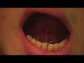Tongue Frenulum Tongue Frenulum