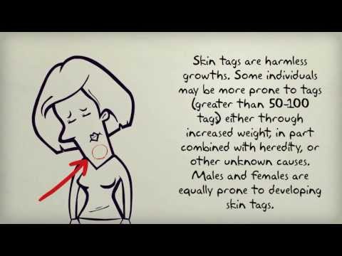 how to remove skin tags yourself