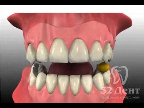 Протезирование мягкими зубными протезами