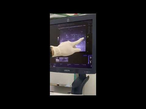 Phần 2: Nguyên lý và cách luyện tập - đường kim vuông góc mặt phẳng đầu dò