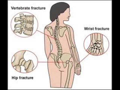 how to control osteoporosis