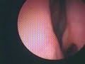 Nasal Polyps