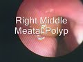 Nasal Polyps Nasal Polyps