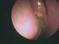 Nasal Polyps