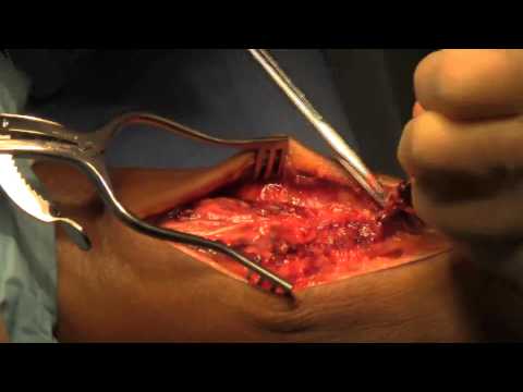 how to snap achilles tendon