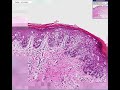 Histopathology-Vulva