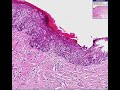 Histopathology-Vulva