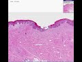 Histopathology-Vulva