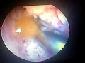 artroscopia de rodilla con menisectomia medial y lateral,+ restauracion ligamento cruzado