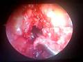 artroscopia de rodilla con menisectomia medial y lateral,+ restauracion ligamento cruzado