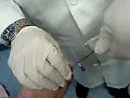 Toe Piercing Removal