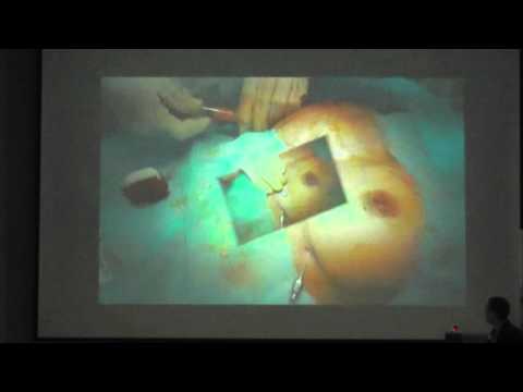 Доклад хирурга клиники «Инновация» А. Петаха. «Аутолипо-трансплантация в реконструктивной хирургии молочной железы». Украина.