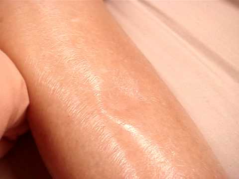 how to measure pitting edema