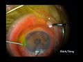 Goniotomy Avastin Injection Right Eye