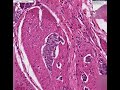 Histopathology Small intestine--Carcinoid tumor