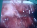 laparascopic cholecystectomy