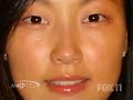 asian plastic surgery patient talks about her surgery