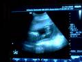 videos de Amanda Ingram's Ultrasound #2... Look a like a penis. ITS A BOY!