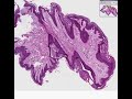 histopathology skin--fibroepithelial polyp (skin tag)