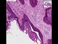 Histopathology Skin--Fibroepithelial polyp (skin tag) Histopathology Skin--Fibroepithelial polyp (skin tag)