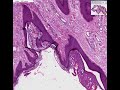histopathology skin--fibroepithelial polyp (skin tag)