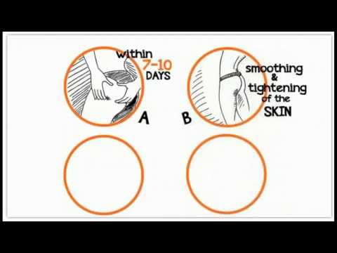how to get rid qones