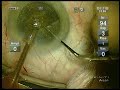 docdepe brown cataract ozil 2.2