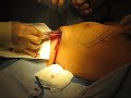 Saline Implant Surgery