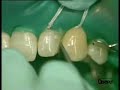 Ceram X duo Diastema Dr. B.Klaiber /2
