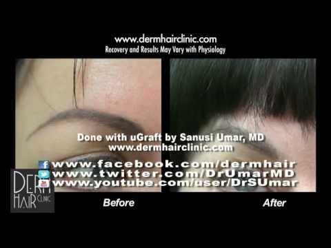 how to transplant eyebrows