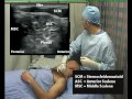 Interscalene Block (ultrasound guided - in plane)