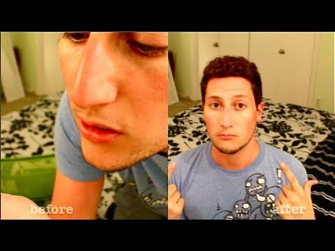 how to recover sunburn