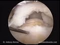 From Open to Arthroscopic Rotator Cuff Repair with Anthony A. Romeo, M.D., Part 4 From Open to Arthroscopic Rotator Cuff Repair with Anthony A. Romeo, M.D., Part 4