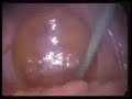 Diagnostic Laparoscopy