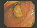 Dr Hiromi Shinya -- Colon therapy