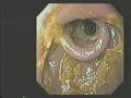 Dr Hiromi Shinya -- Colon therapy